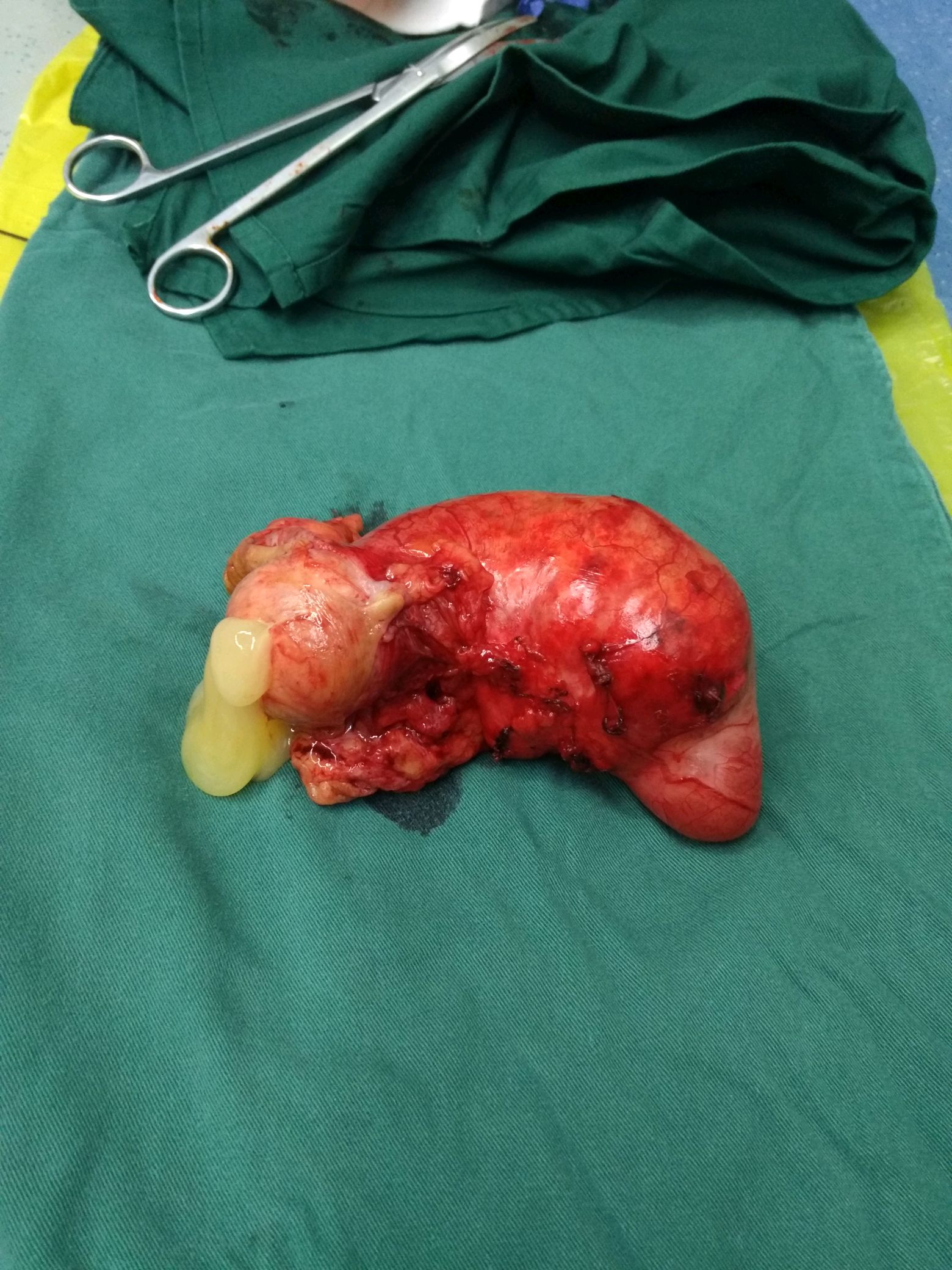 小尾巴的大麻烦——阑尾也有肿瘤?