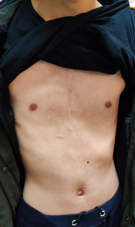 改良wang手术:心脏术后大面积漏斗胸的矫治手术-王文林主任医师-爱问