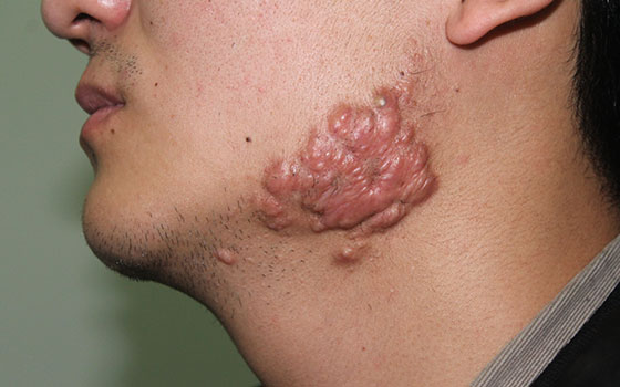 使用激素治疗瘢痕疙瘩的原理是什么?