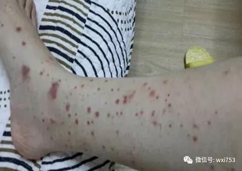 过敏性紫癜:医生给开了抗凝药物,这病是凝血功能障碍引起的吗?