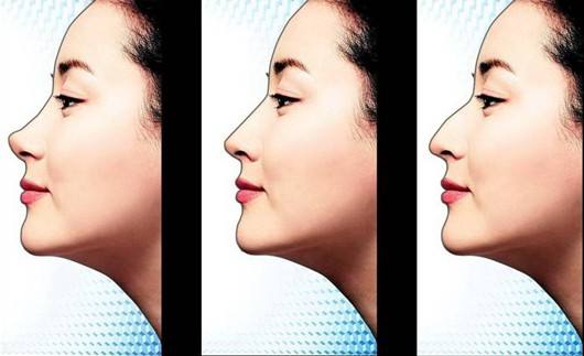 盘点几种常见的不良鼻型,你中招了吗?