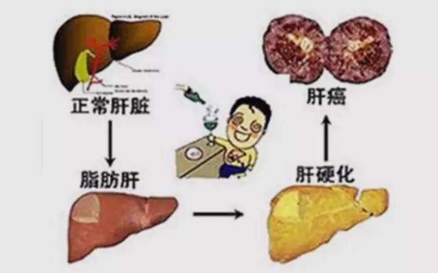 酒精肝会演变成肝癌别不信