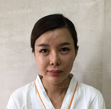 刘波全肋隆鼻修复305—409天案例日记分享-刘波主治医师-爱问医生