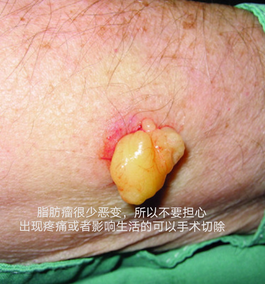 脂肪瘤恶化图片