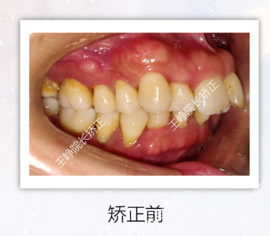 明顯的可以看到,咬合關係正常,深覆蓋解除,牙列排齊了.