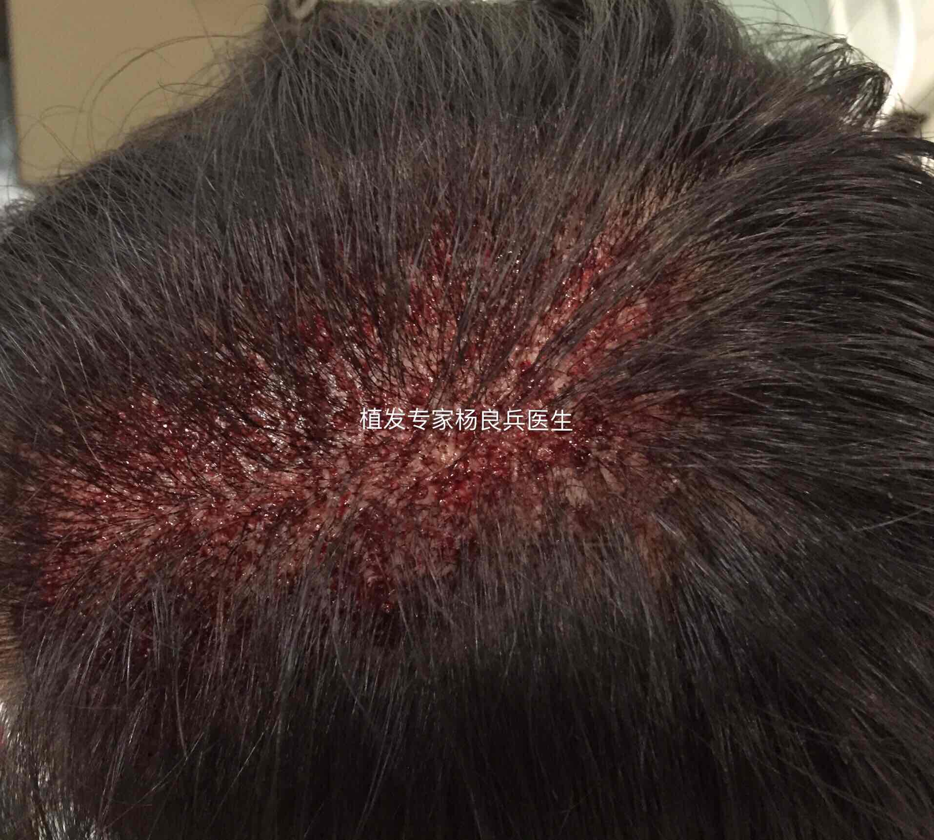 拔毛癖及其治疗