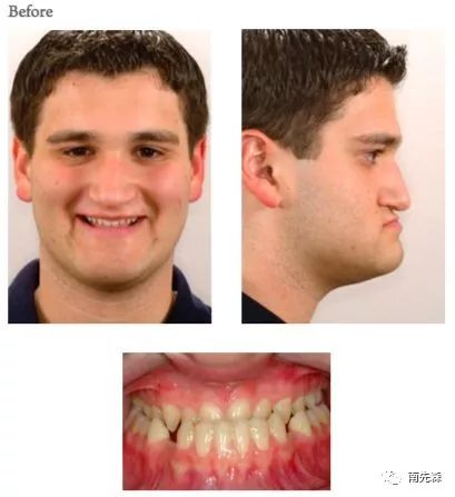 那就按上图所示,下颌骨矢状锯开,劈开,前移↓ 上颌的 leforte i型截骨