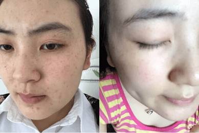 理论界论证雌激素过高可刺激黑色素细胞,分泌黑色素颗粒增多,黄体酮能