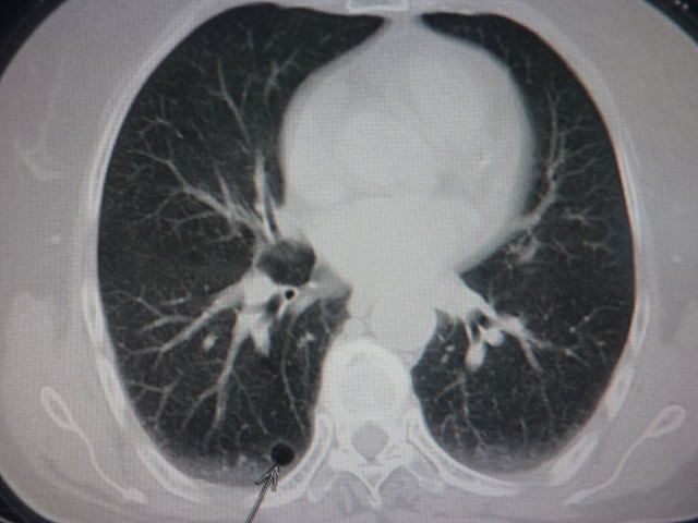肺大泡x线胸片图解图片