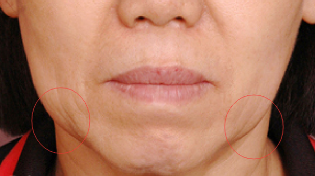 吕晓杰:如何甩掉垂垂的嘴边肉?