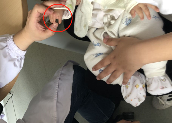 新生儿波兰综合症图片图片