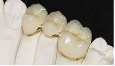 (2)对后牙末端游离缺失的患者,若用固定桥修复,桥体受力,产生的杠杆