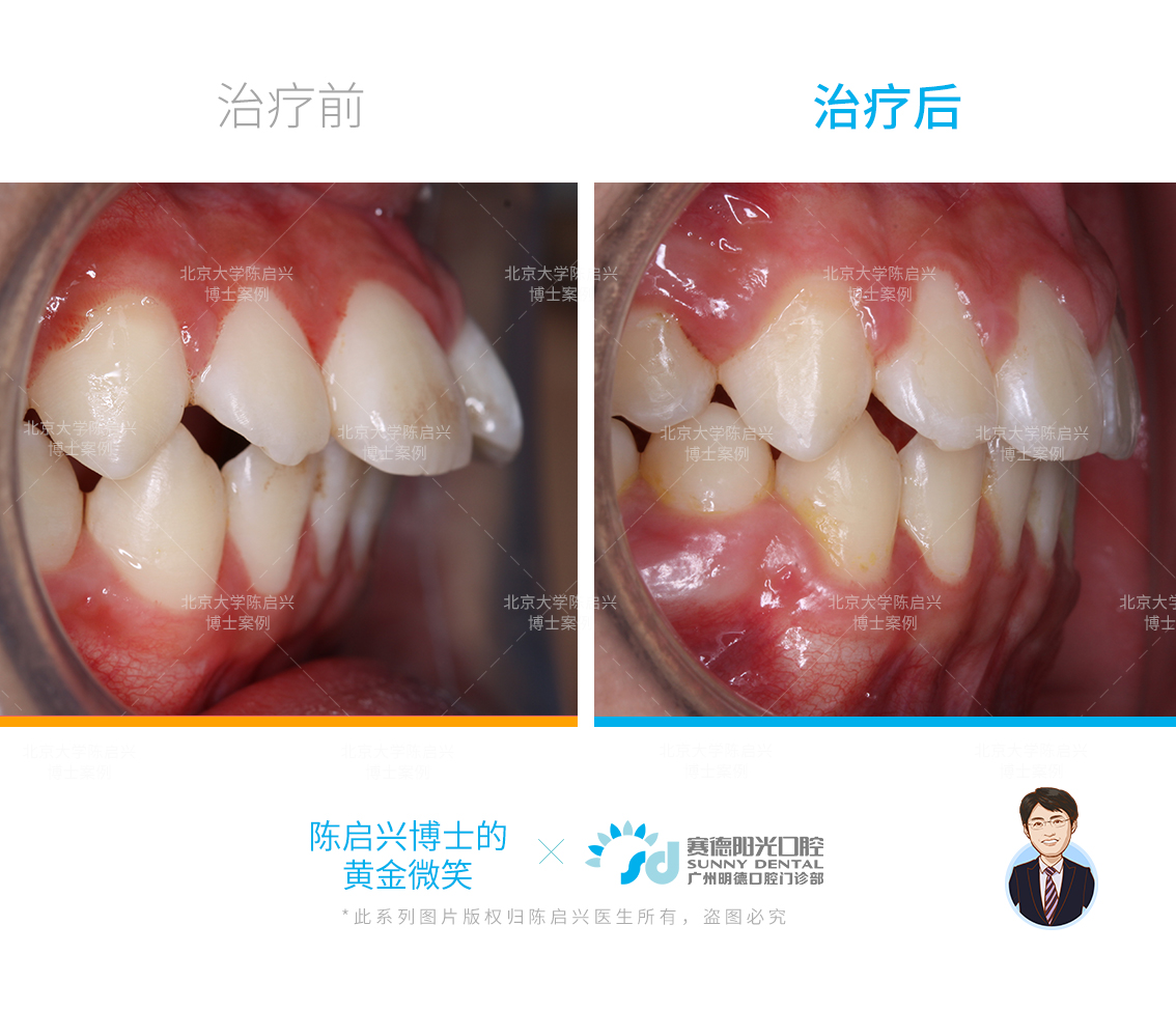 腺样体肥大门牙外凸图片