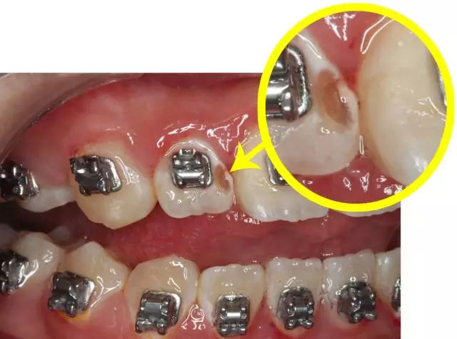 正畸会让牙齿脱矿小白斑都是怎么来的