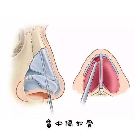 鼻中隔软骨在哪里图片