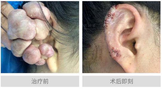 疤痕疙瘩长在耳朵上应如何治疗?