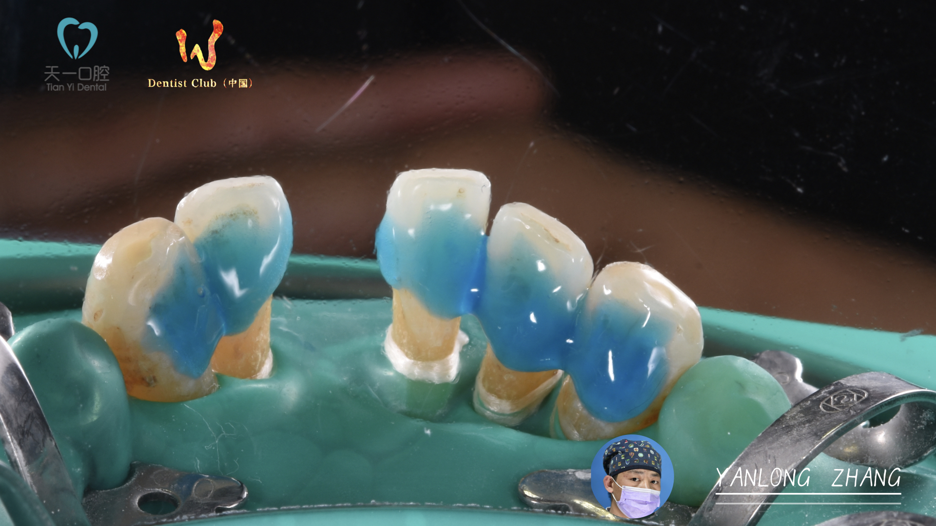 选择芬力粘接桥修复,恢复缺失前牙,重拾光辉岁月,还他幸福晚年!2.