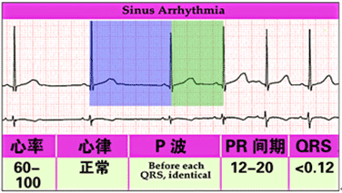 窦性心律不齐是病吗