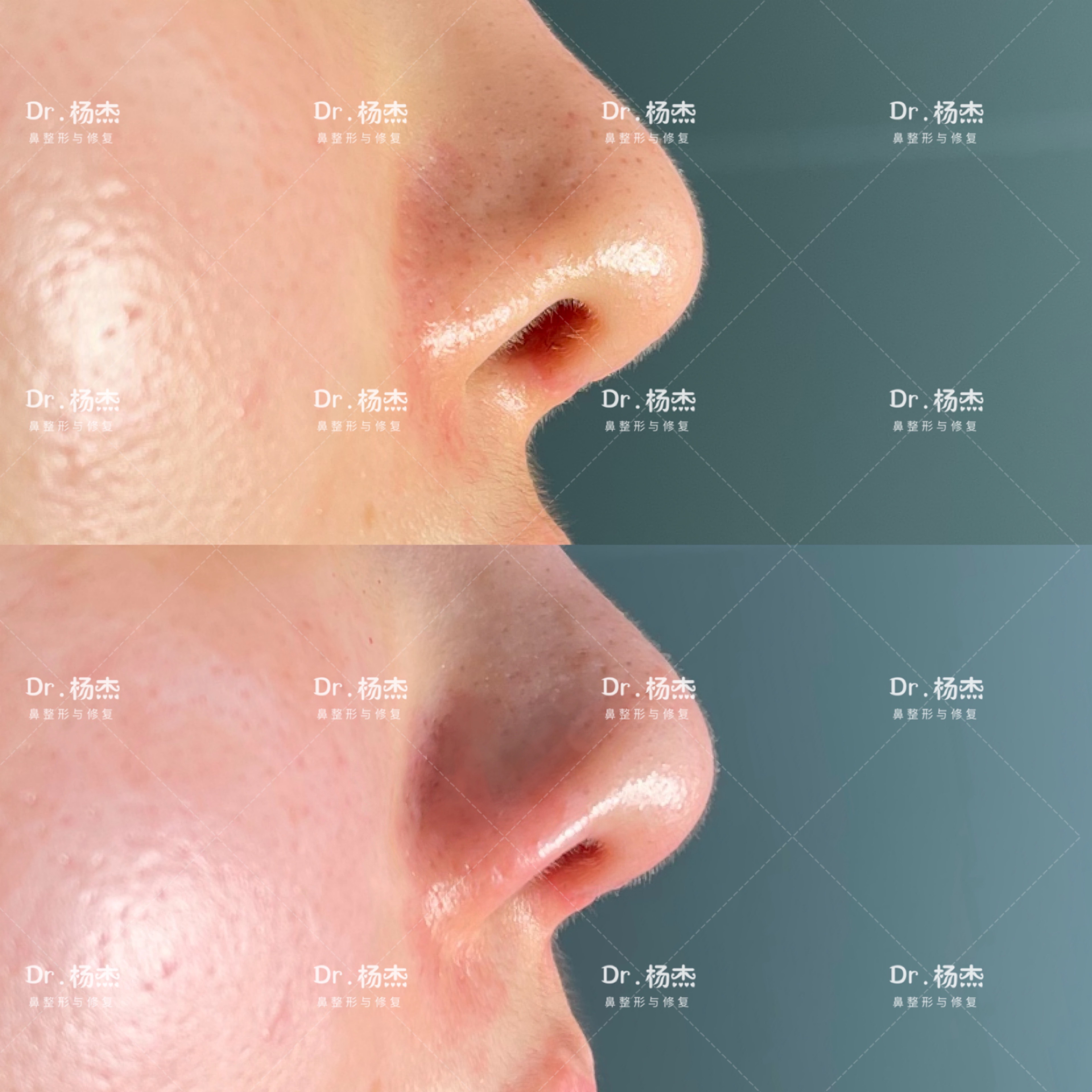挛缩鼻修复案例，术后两个半月对比图分享-深圳李信锋隆鼻整形 - 知乎