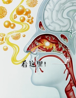 鼻后滴漏综合症 新浪（移动端）