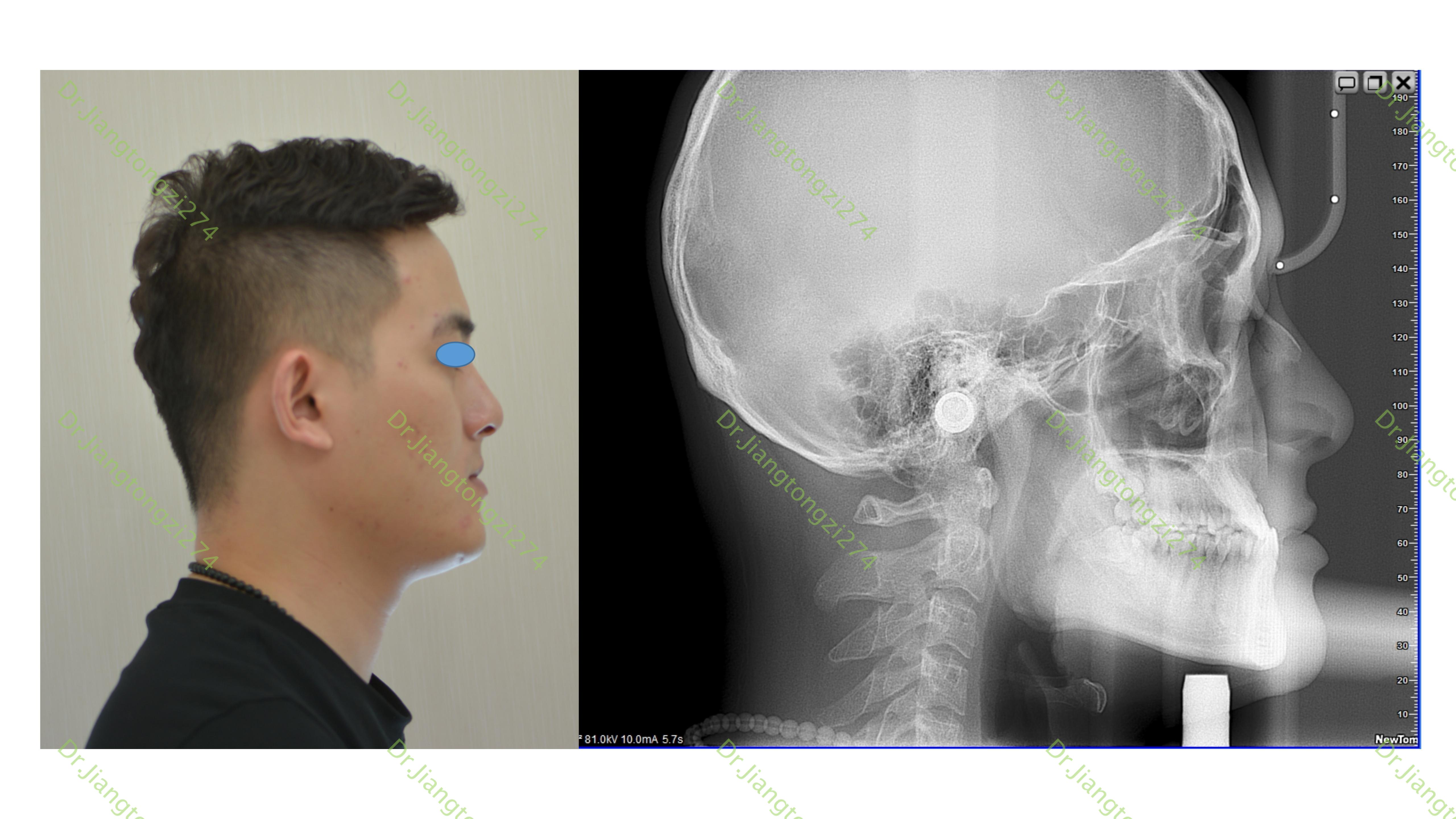 《正畸病例77:成人地包天的隐形矫正》