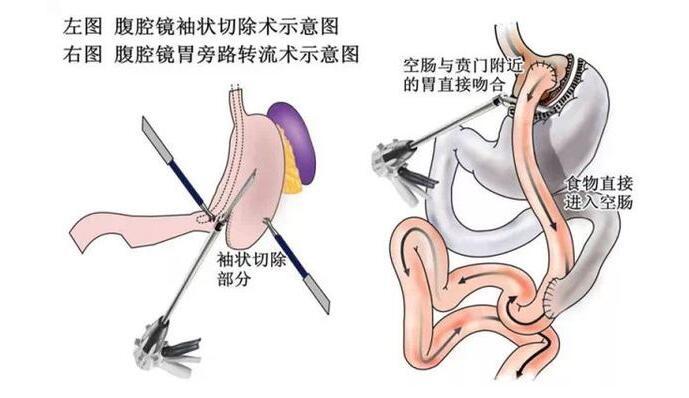 你了解减重手术后怎么饮食吗