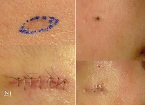 关于疤痕直接切除缝合后的延长