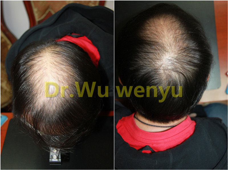 案例分析 植发一年头发长成什么样 医生说 39健康网