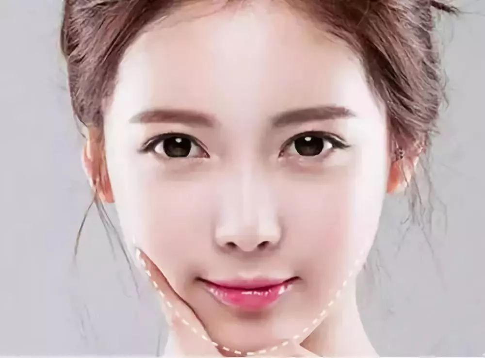 相关医美项目:瘦脸针,面部吸脂手术,下颌角切除术等.