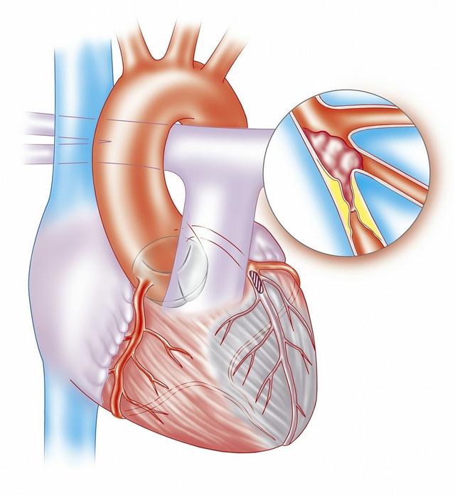 冠状动脉狭窄不超过50%就不用管吗?尽早控制心血管风险很重要