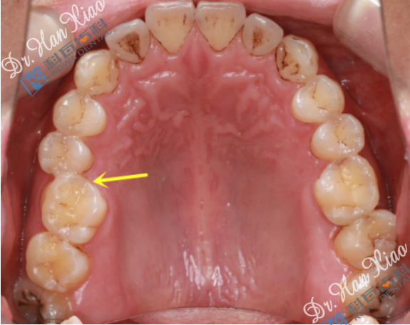 你的牙没缺没烂就是嚼不动有可能是后牙锁合在搞事情