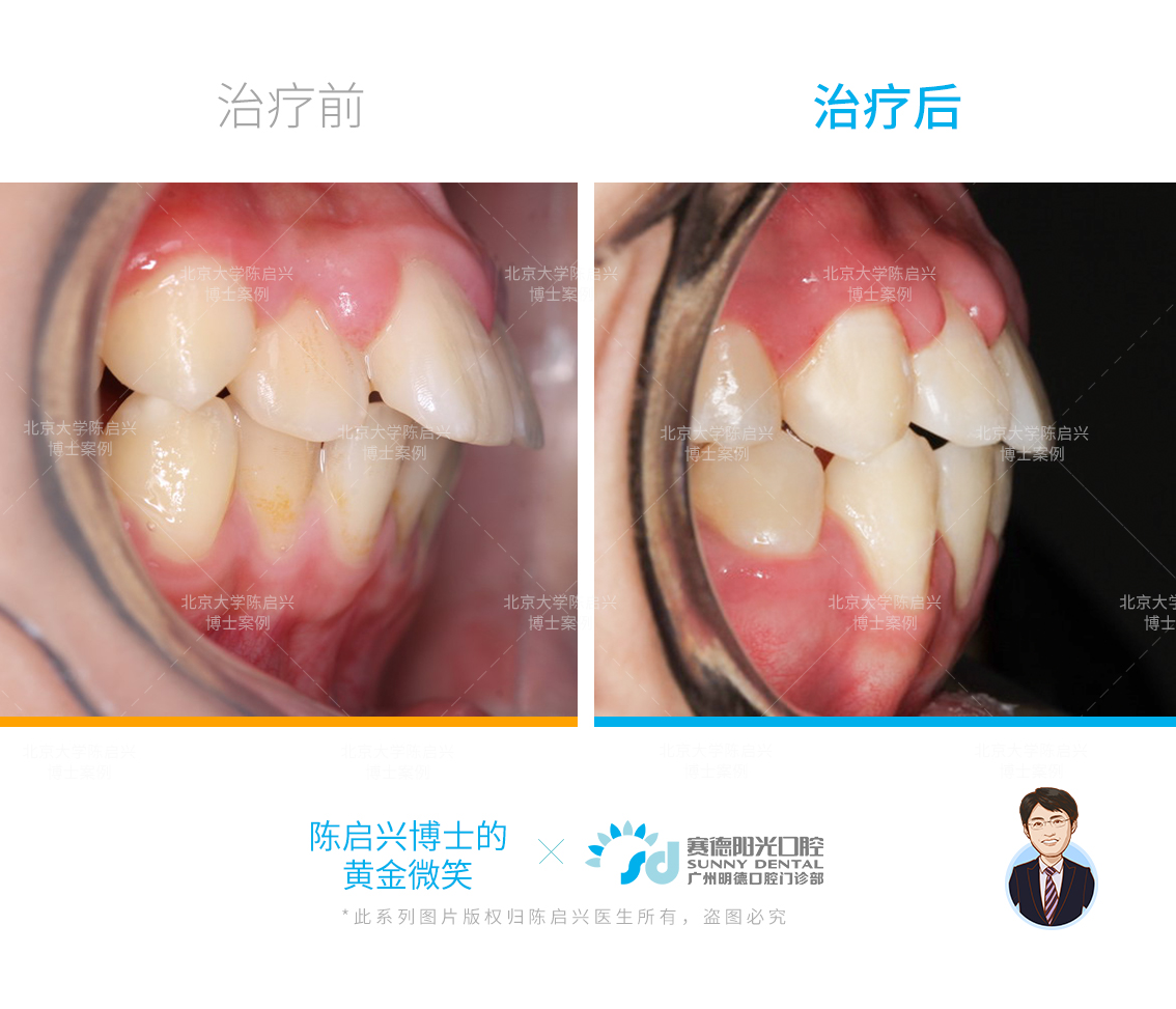 口呼吸腺樣體面容矯正案例