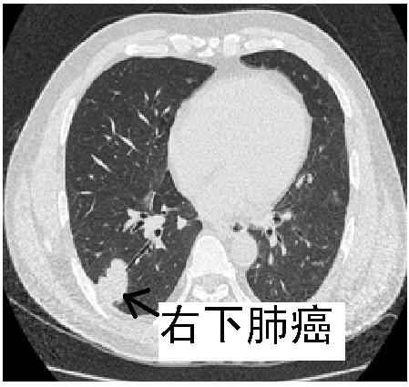 进一步行ct检查:右下肺基底段31*21mm结节,怀疑周围型肺癌