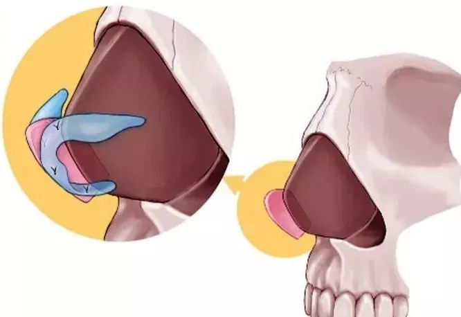 鼻小柱延长术修复缺陷鼻型