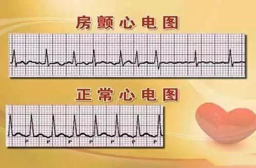 心脏跳乱了房颤发生,是快心率好?还是慢心率好?医生说明!