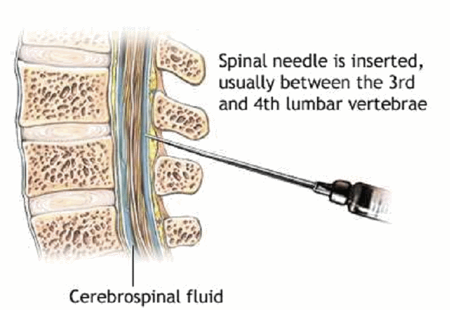 腰椎穿刺(目的抽取脑液)的历史