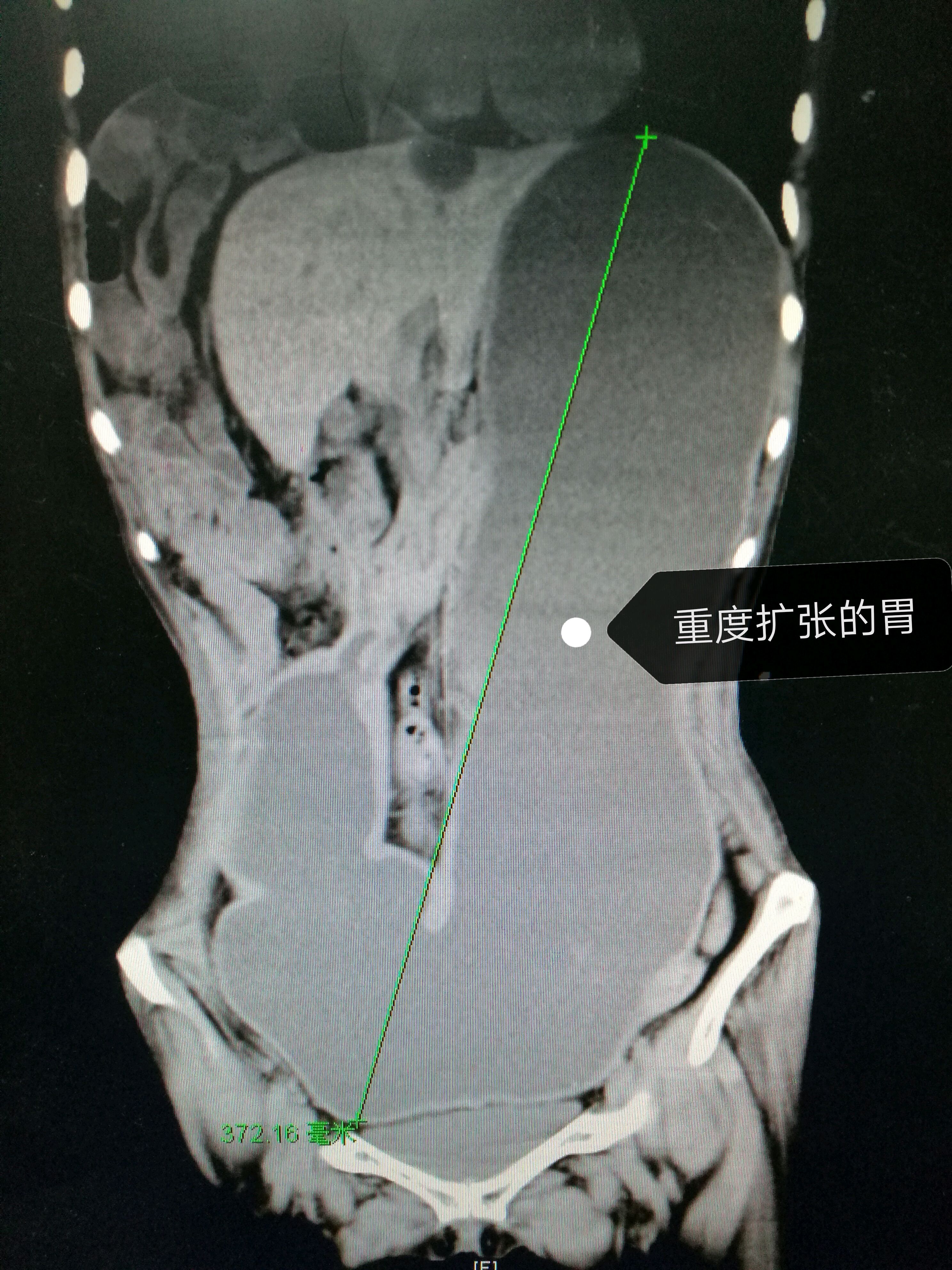 胃潴留-你的胃竟然可以扩张到这么大!