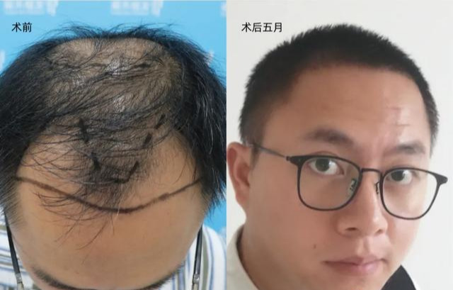 985大学男博士秃顶,单身,他发帖:我会被女生嫌弃吗?