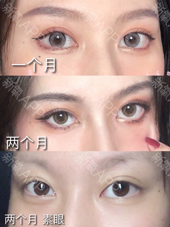 实际上很多时候并不是割的不好,而是你选择的双眼皮