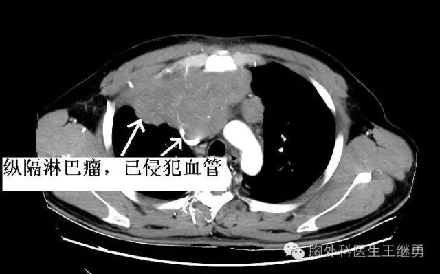 纵隔肿瘤怎么治?