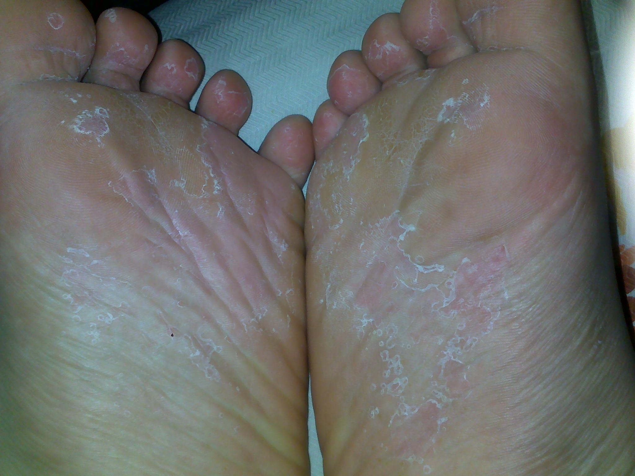 别让足癣有可乘之机