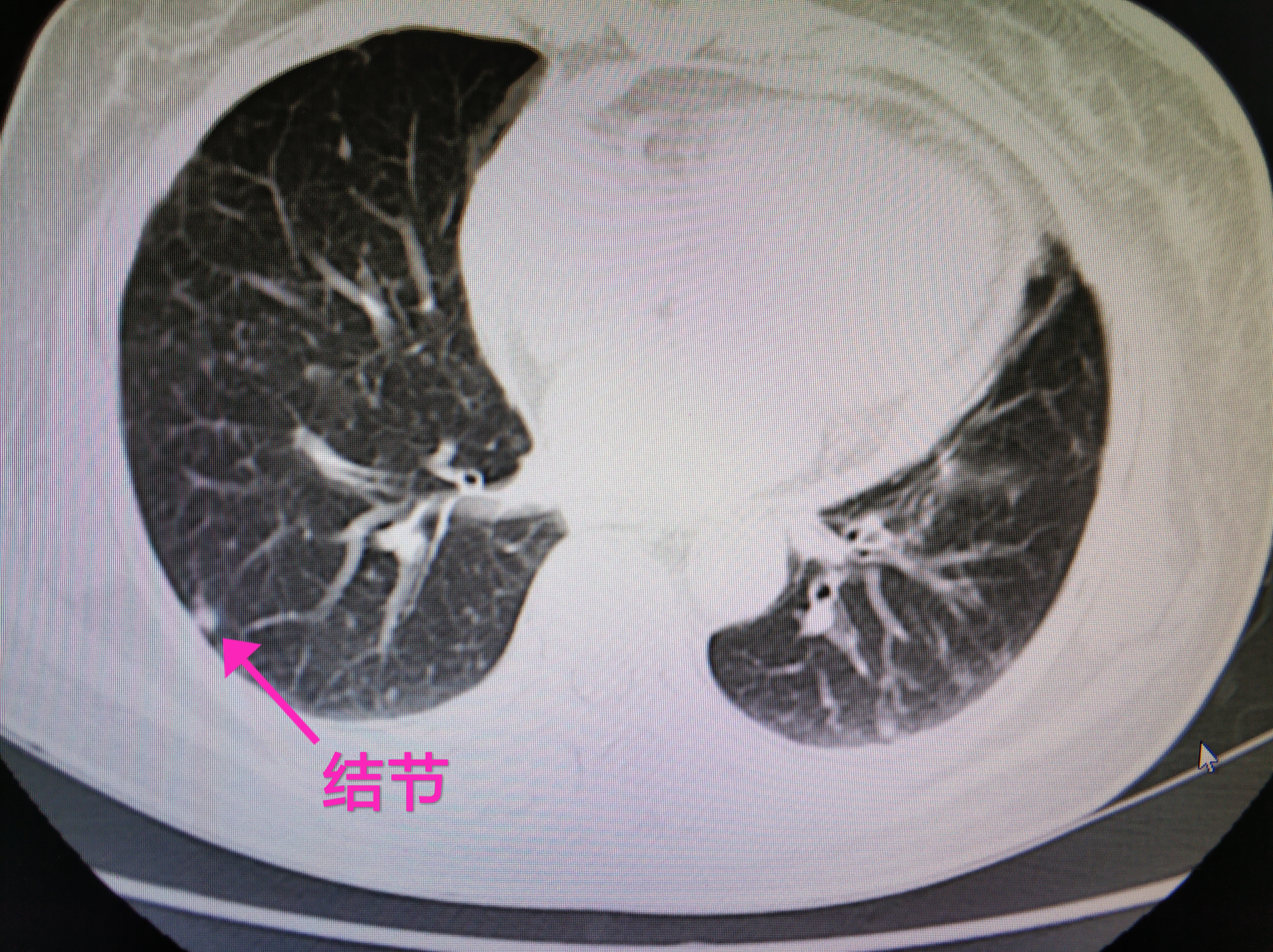 肺部结节图片查看图片