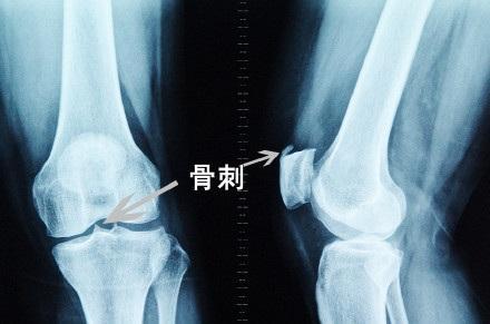 骨刺是怎么产生的拇指外翻怎么办粉丝答疑你想知道的都在这