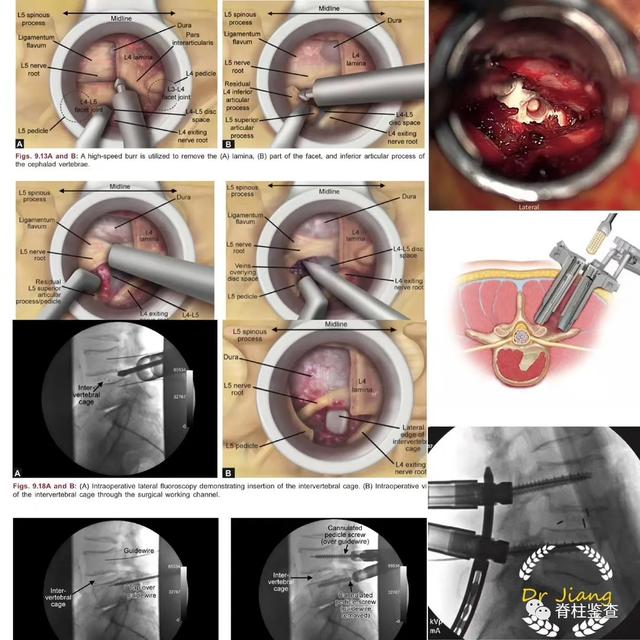 此病例采用mistlif, 为微创下的通道下减压固定融合术,这种手术也是
