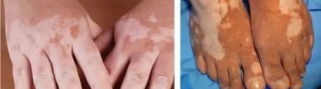 左圖),大於2mm為瘀斑(ecchymosis,右圖)圖一:牛奶咖啡