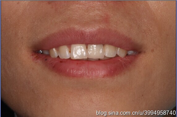 单颗前门牙全瓷修复仿真病例