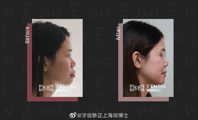 掩饰性治疗一般分为两类. 一类是上颌前突下颌后缩 ,一类是反颌 .