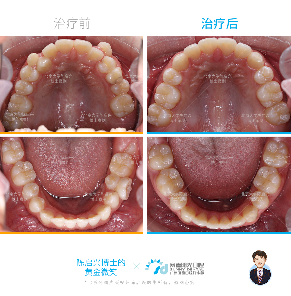 北京牙齿矫正林琳案例分享：深覆合深覆盖，牙齿前突，牙齿拥挤 - 知乎