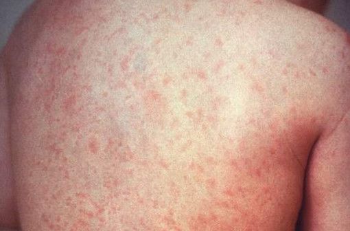 在学龄儿童群体内较为常见的一种病毒疹风疹