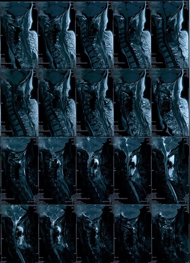 床突间韧带钙化影像图图片